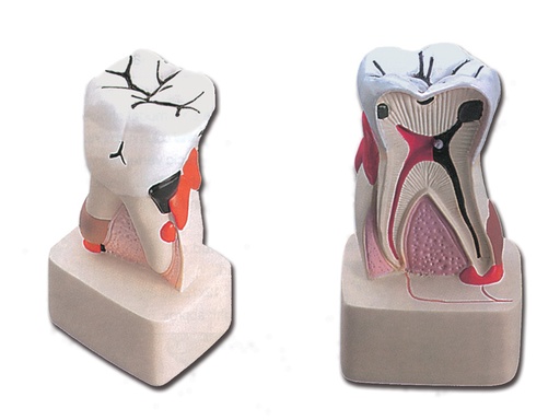 [40212] MODELLO PATOLOGIA DENTALE